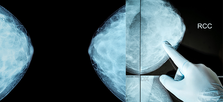 Röntgenbilder på bröstvävnad.