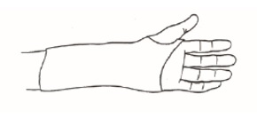 illustration 1: hand med gipsskena