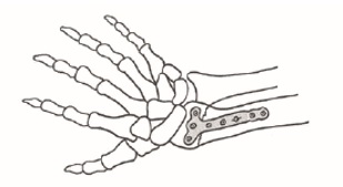 illustration 2: hand med metallplatta