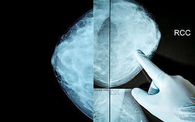 Röntgenbilder på bröstvävnad.